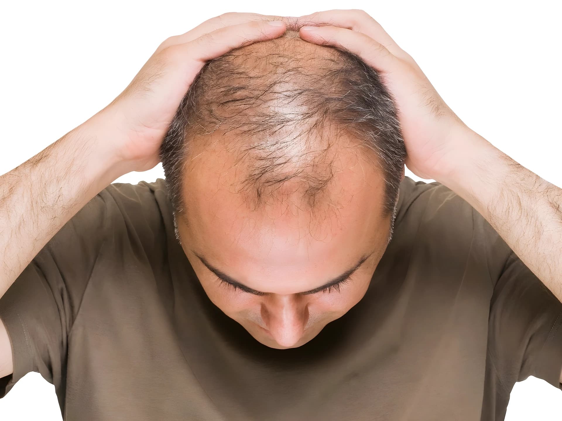 Stress తీసుకుంటే.. Hair Fall తప్పదా?