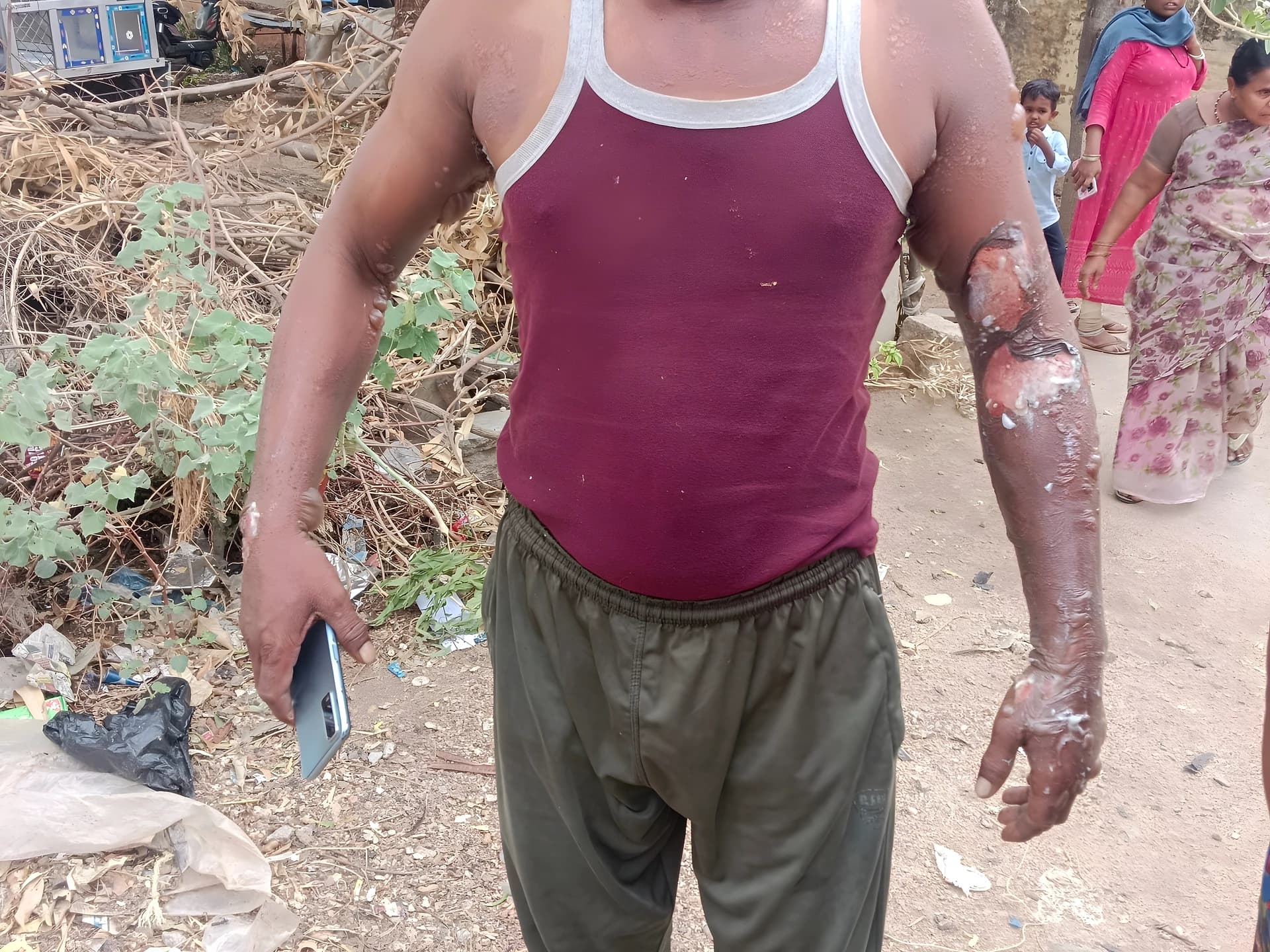 గ్యాస్ సిలిండర్ లీక్.. ఇద్దరికి స్వల్ప గాయాలు!