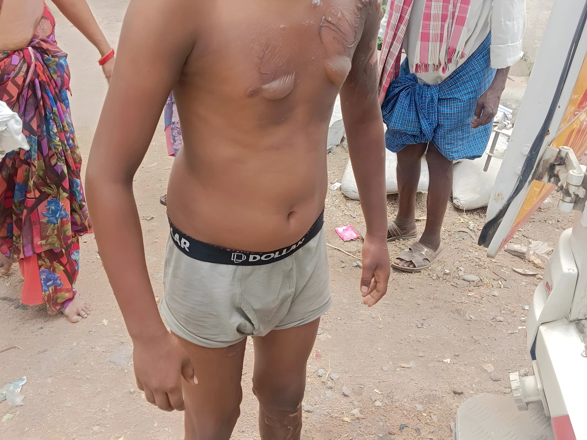 గ్యాస్ సిలిండర్ లీక్.. ఇద్దరికి స్వల్ప గాయాలు!